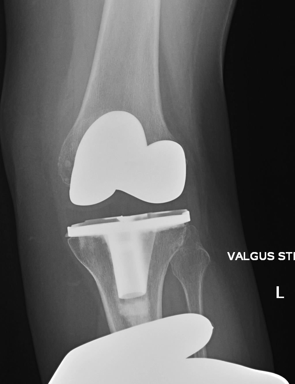 TKR Instability Varus and Valgus 2